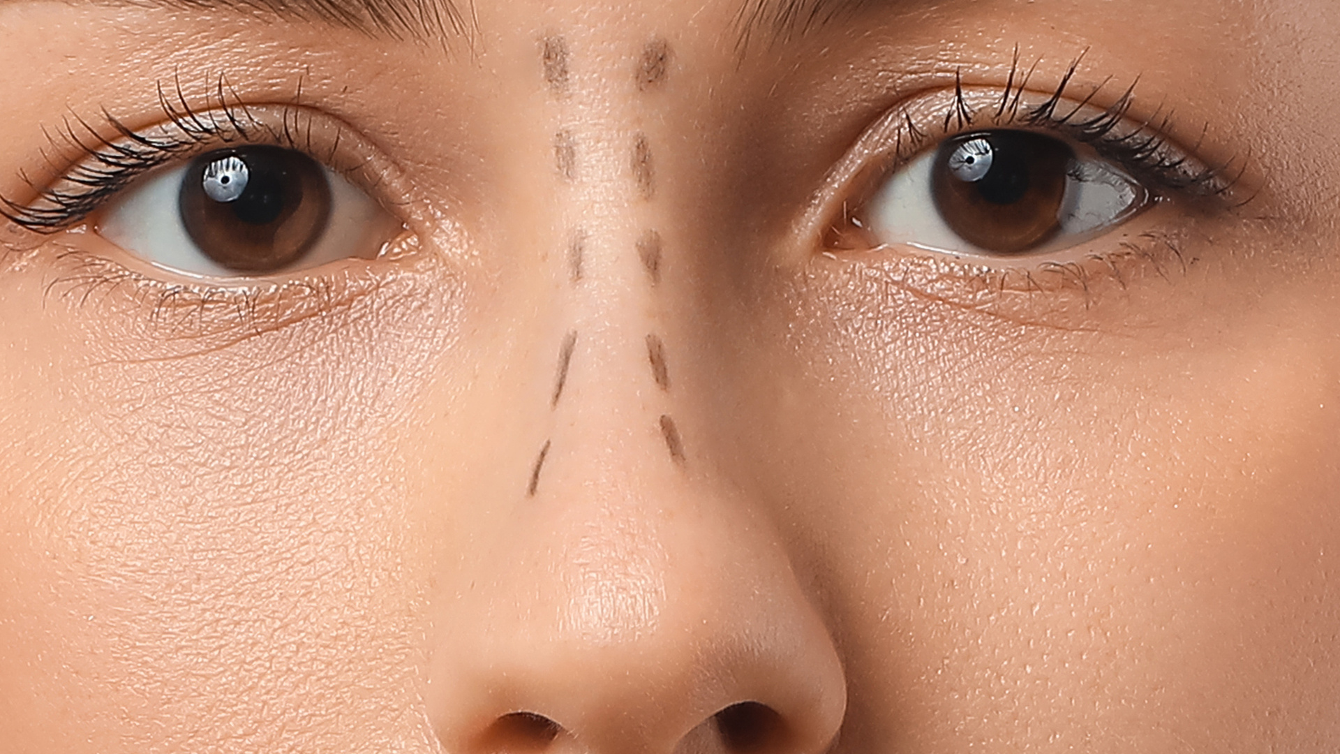 I want a higher nose bridge but don't want surgery. Is a nose thread lift a good option?