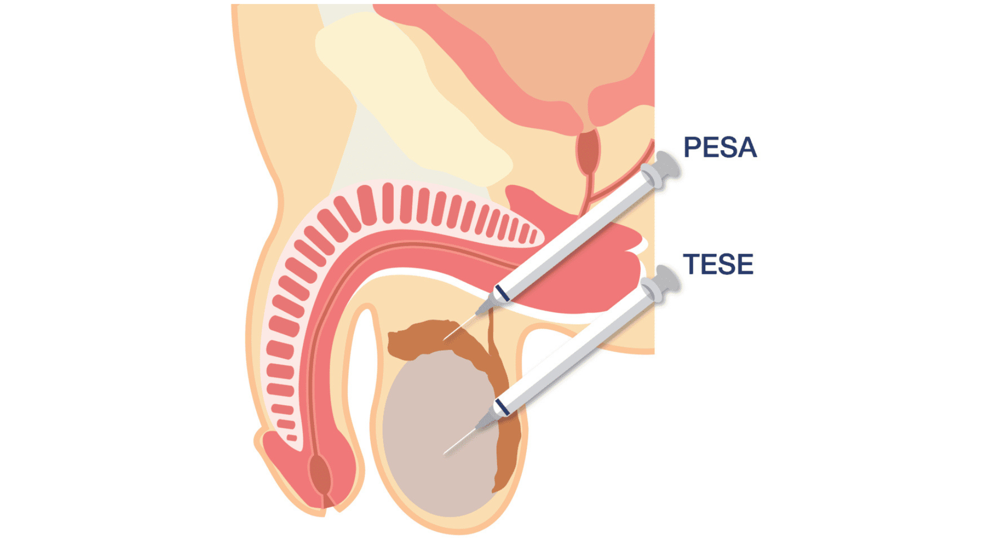 PESA/TESE