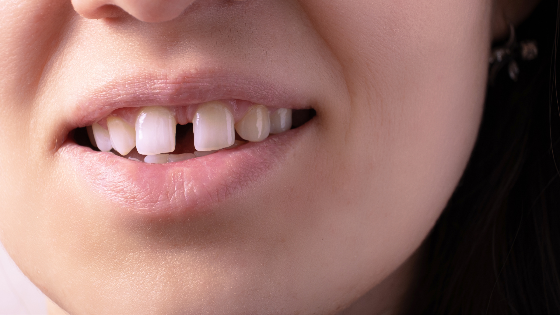 ခြားအား သွားများ (Gap Teeth) ဆွဲငင်သပ်ခြင်း (Orthodontic Treatment) လိုအပ်သလား? သင်မသိသေးသော အခြားရွေးချယ်စရာများကို ရှာဖွေပါ
