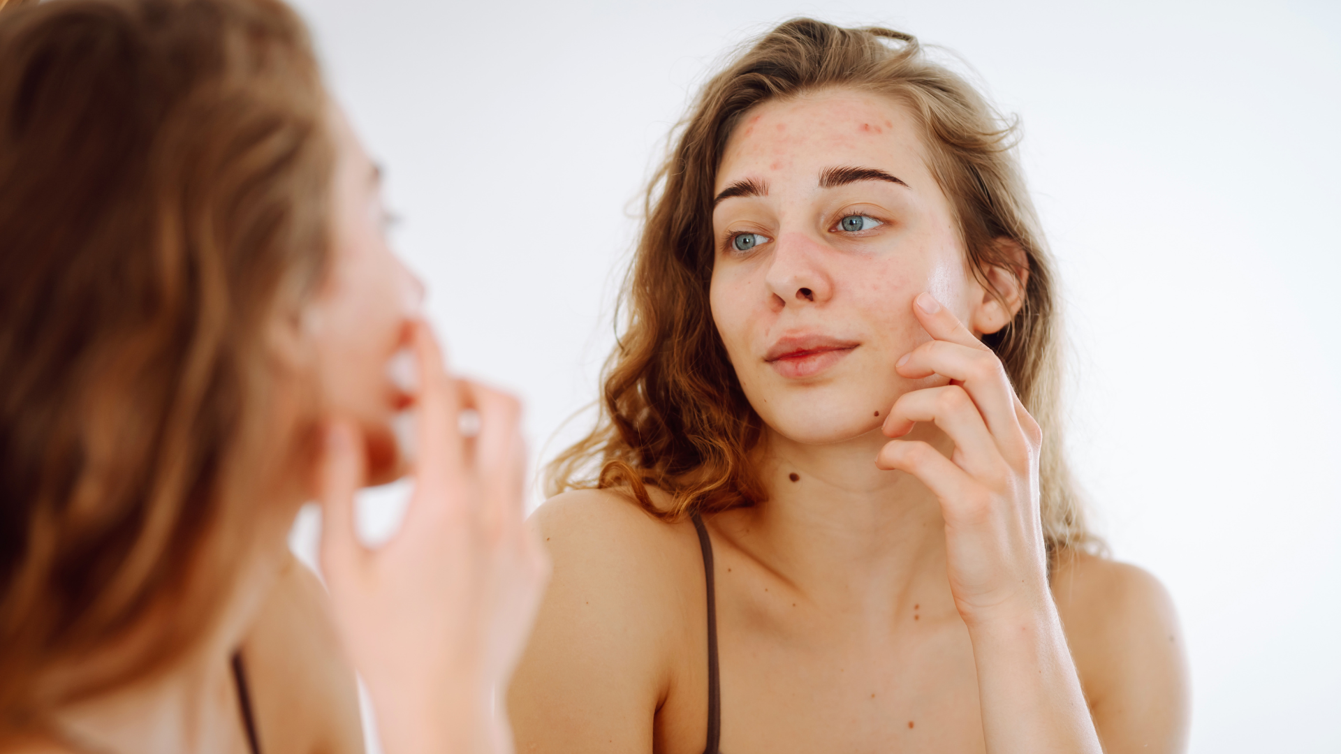 Common Acne Myths That Can Lead to Permanent Acne Scars