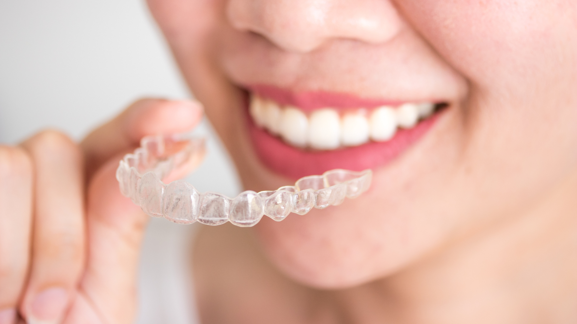 नई पीढ़ी क्यों Invisalign क्लियर एलायनर्स को प्राथमिकता देती है, इसके 10 कारण