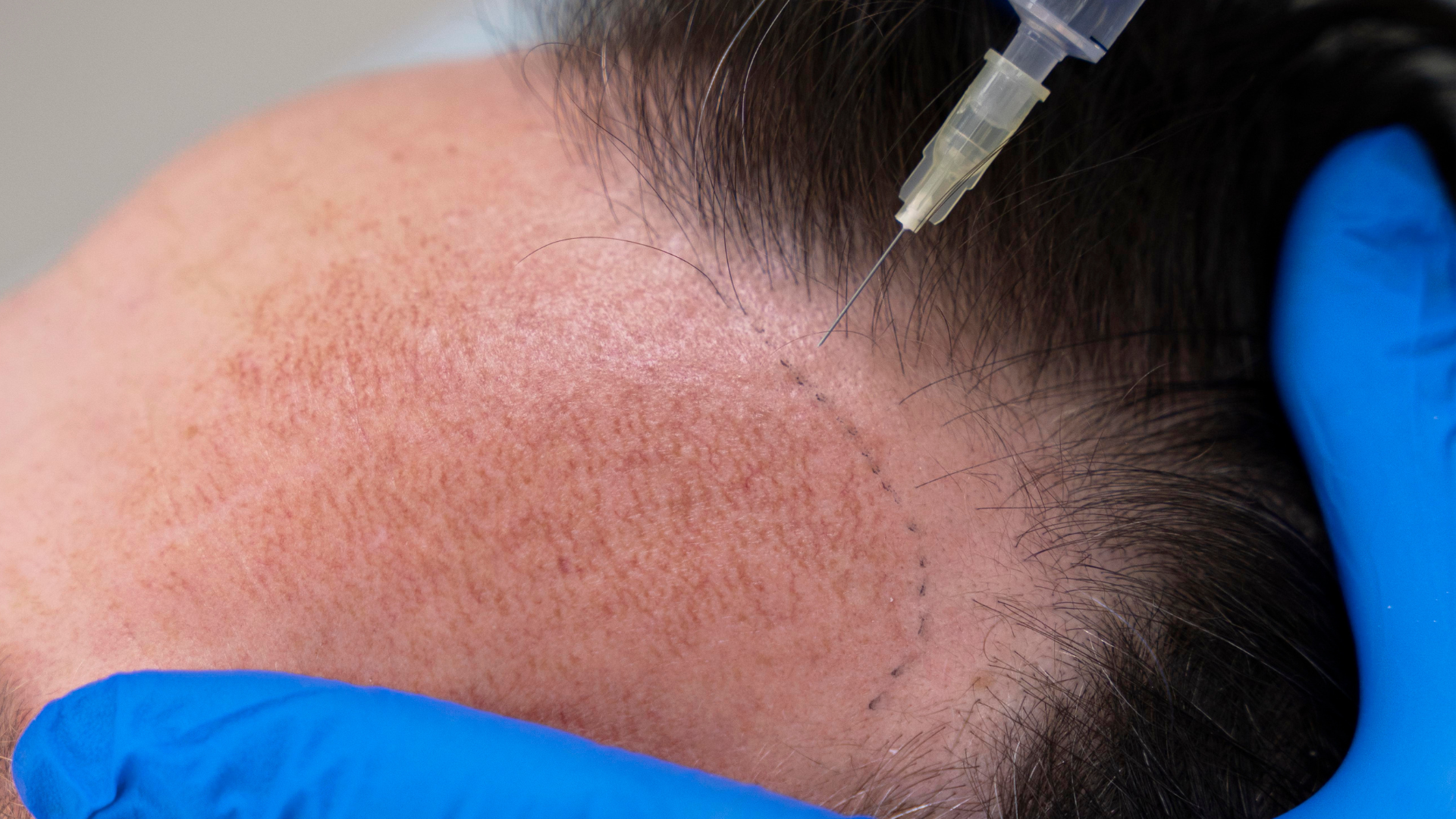 Follicular Unit Extraction(FUE)