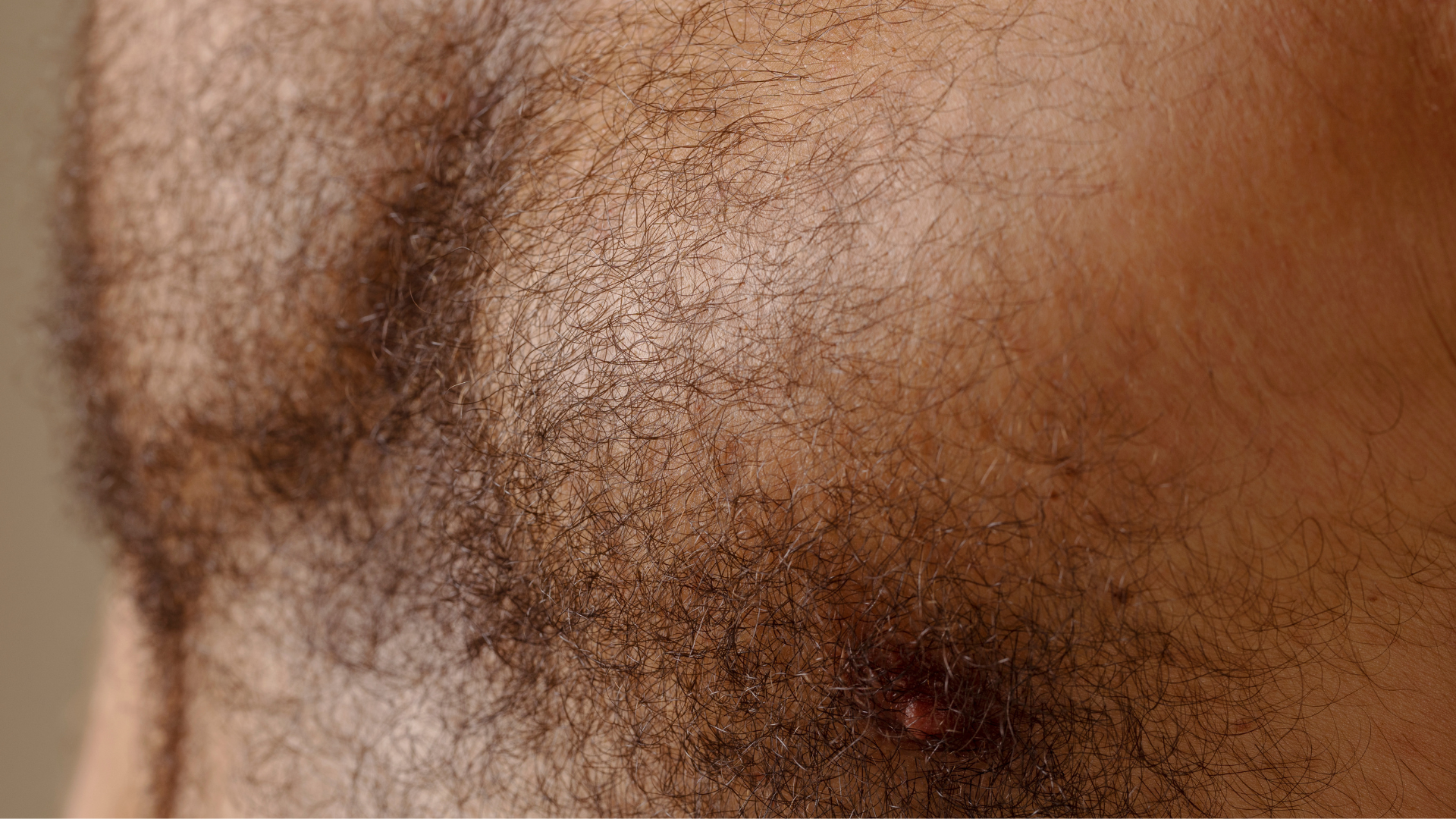 Body Hair Transplantation