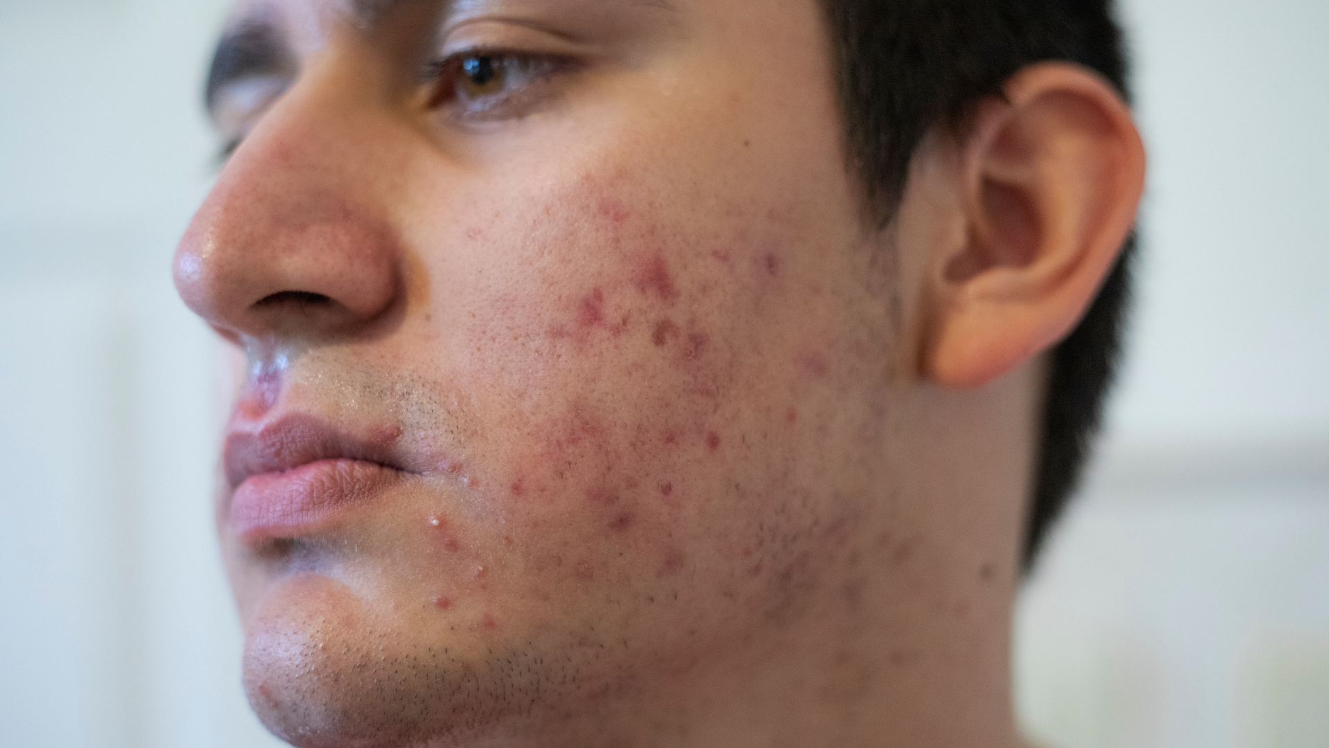 What Is Cystic Acne (Acne Conglobata)?