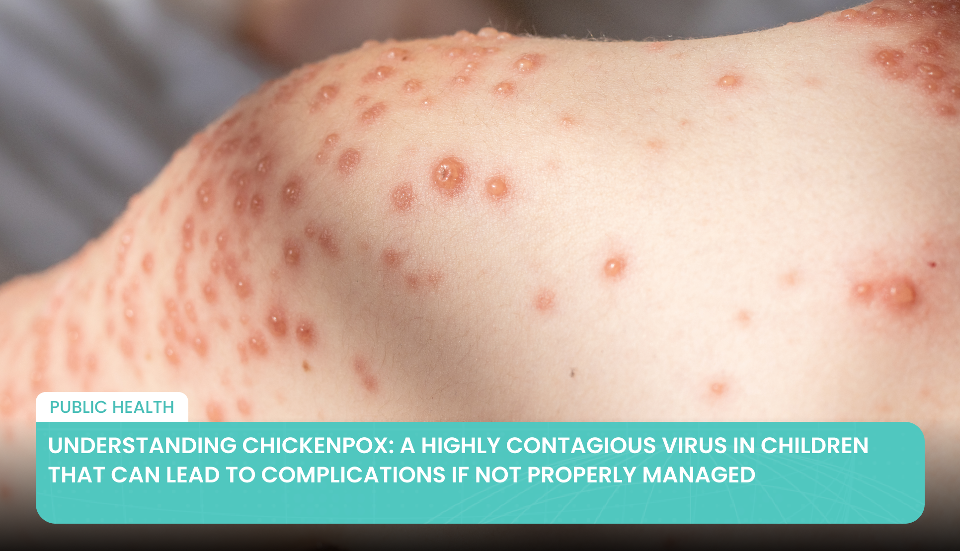 Understanding Chickenpox: A Highly Contagious Virus in Children That Can Lead to Complications if Not Properly Managed