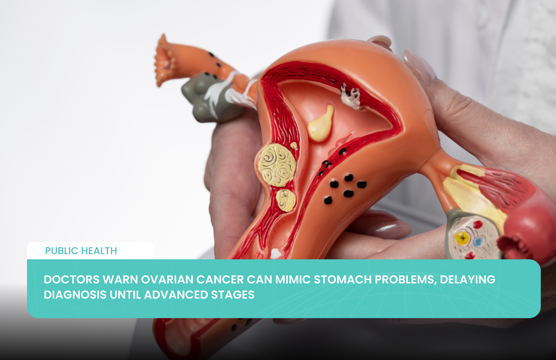 Doctors Warn Ovarian Cancer Can Mimic Stomach Problems, Delaying Diagnosis Until Advanced Stages
