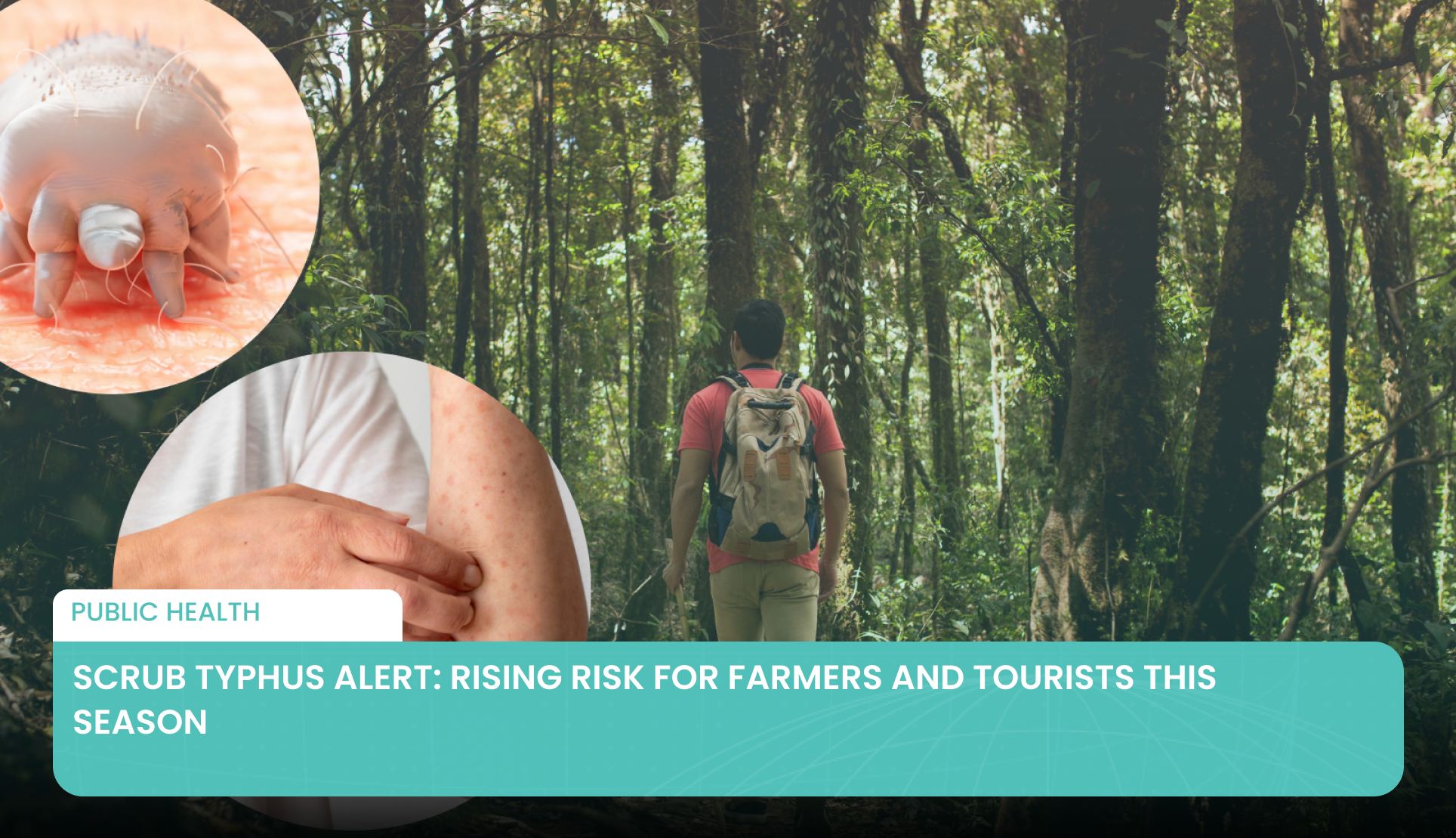 Scrub Typhus Alert: Rising Risk for Farmers and Tourists This Season