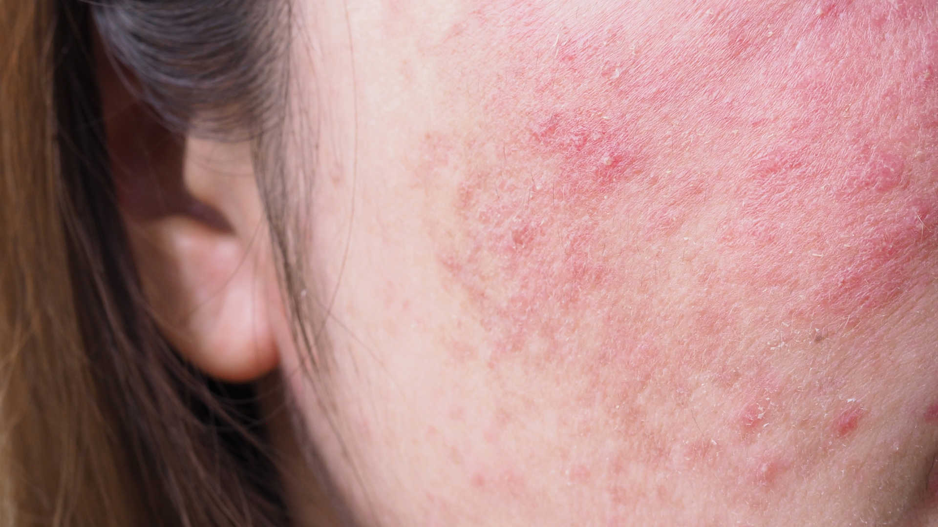 What Is Sensitive Skin? Causes, Proper Care, and Long-Term Solutions for a Stronger Skin Barrier