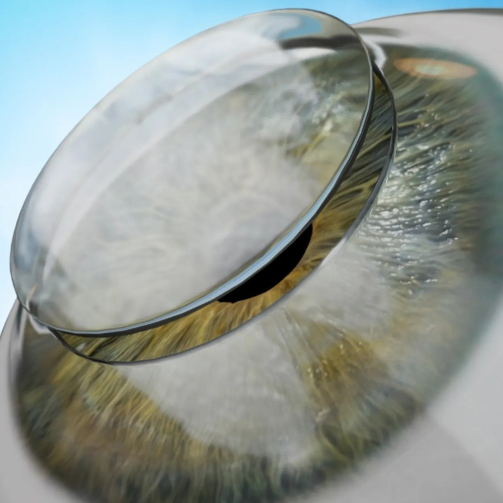 Cornea Center