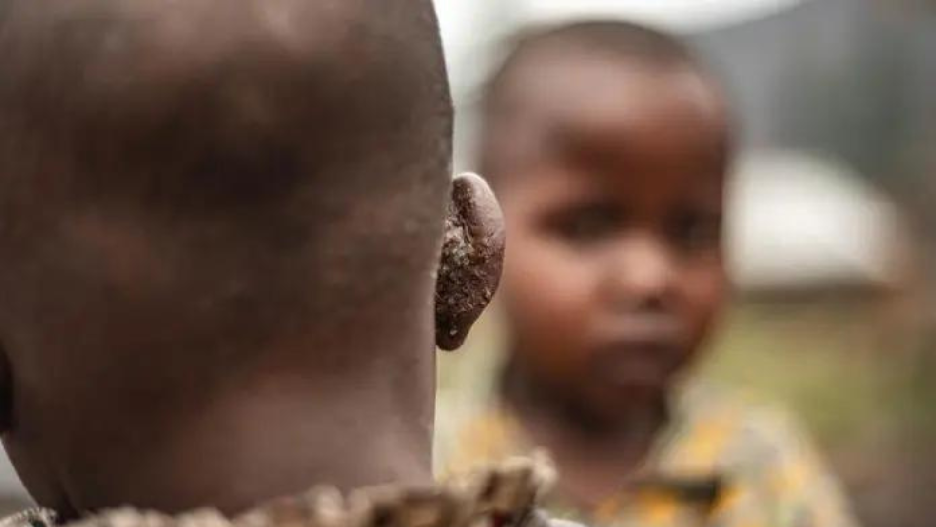 Mpox Cases in Africa Near 30,000