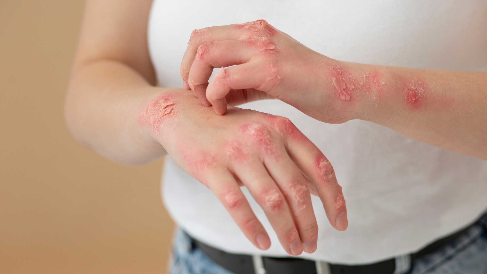 Shingles: More Dangerous Than You Think – Complications from Shingles