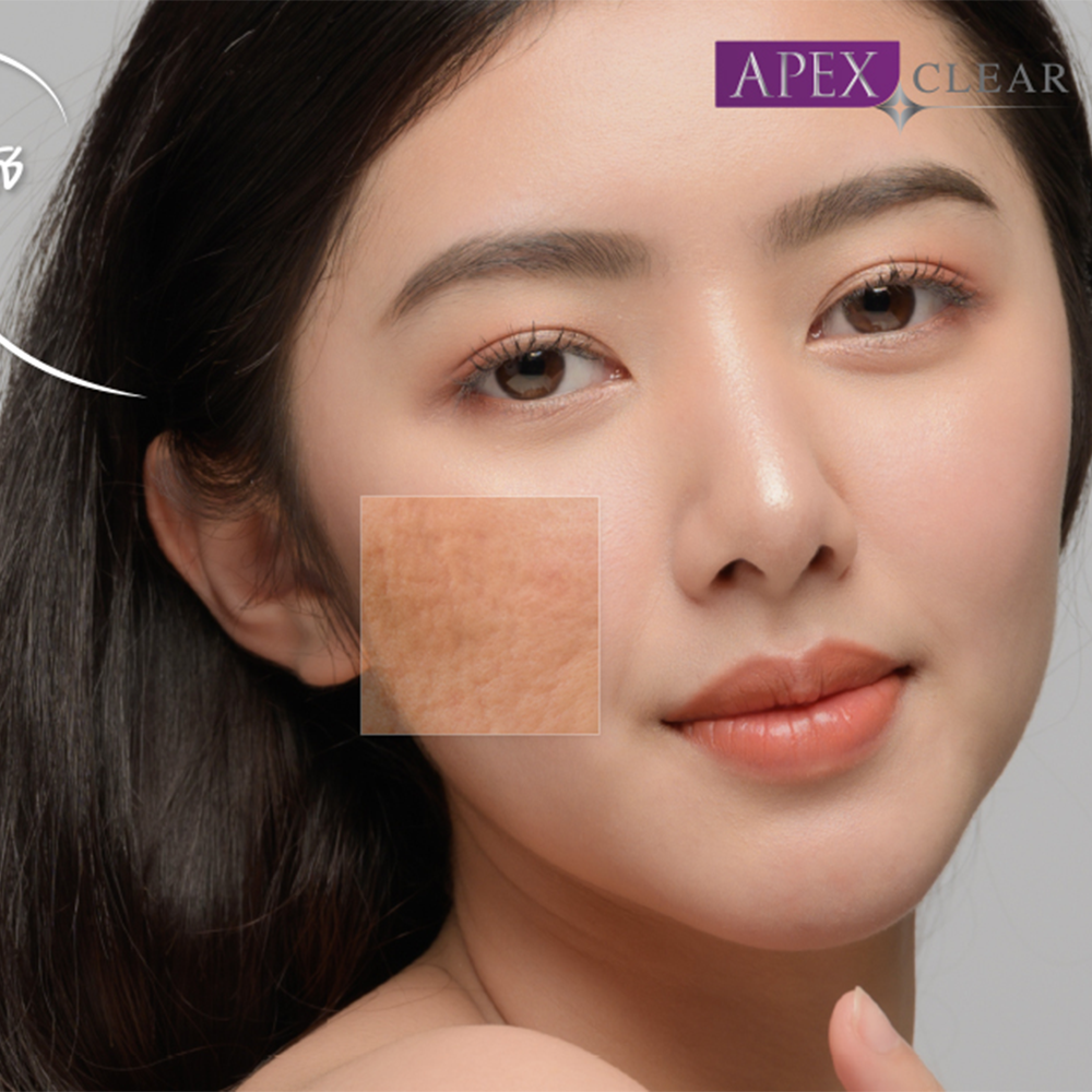 Clear Smooth Program: The Ultimate Solution for Acne Scars