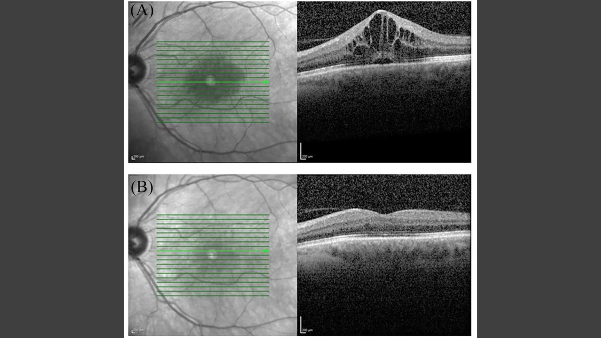 Blurred Vision After Cataract Surgery: Causes, Diagnosis, and Management of Cystoid Macular Edema