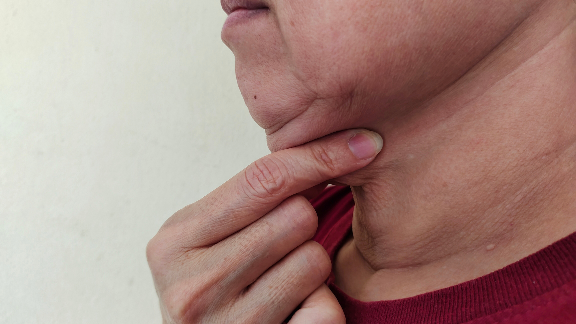 Neck Lift (Platysmaplasty)