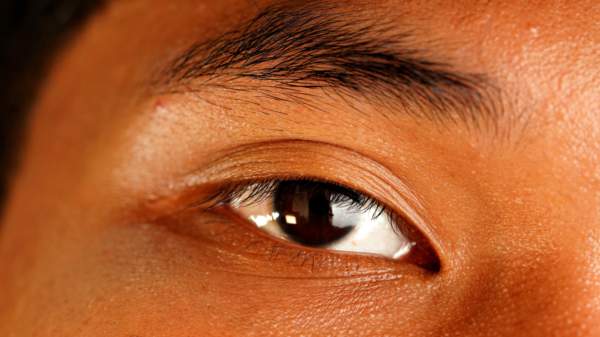 luckyeye Upper Blepharoplasty (Double Eyelid)