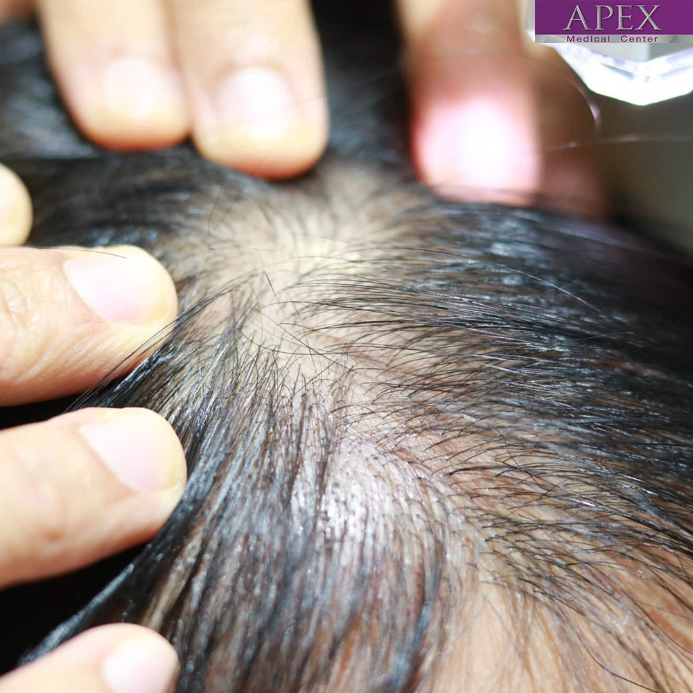 Hair Stem Micro Transplant