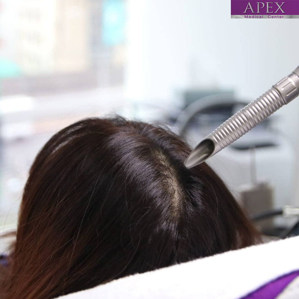 LASER MESO HAIR (LMH): Advanced Laser Technology for Hair and Scalp Health