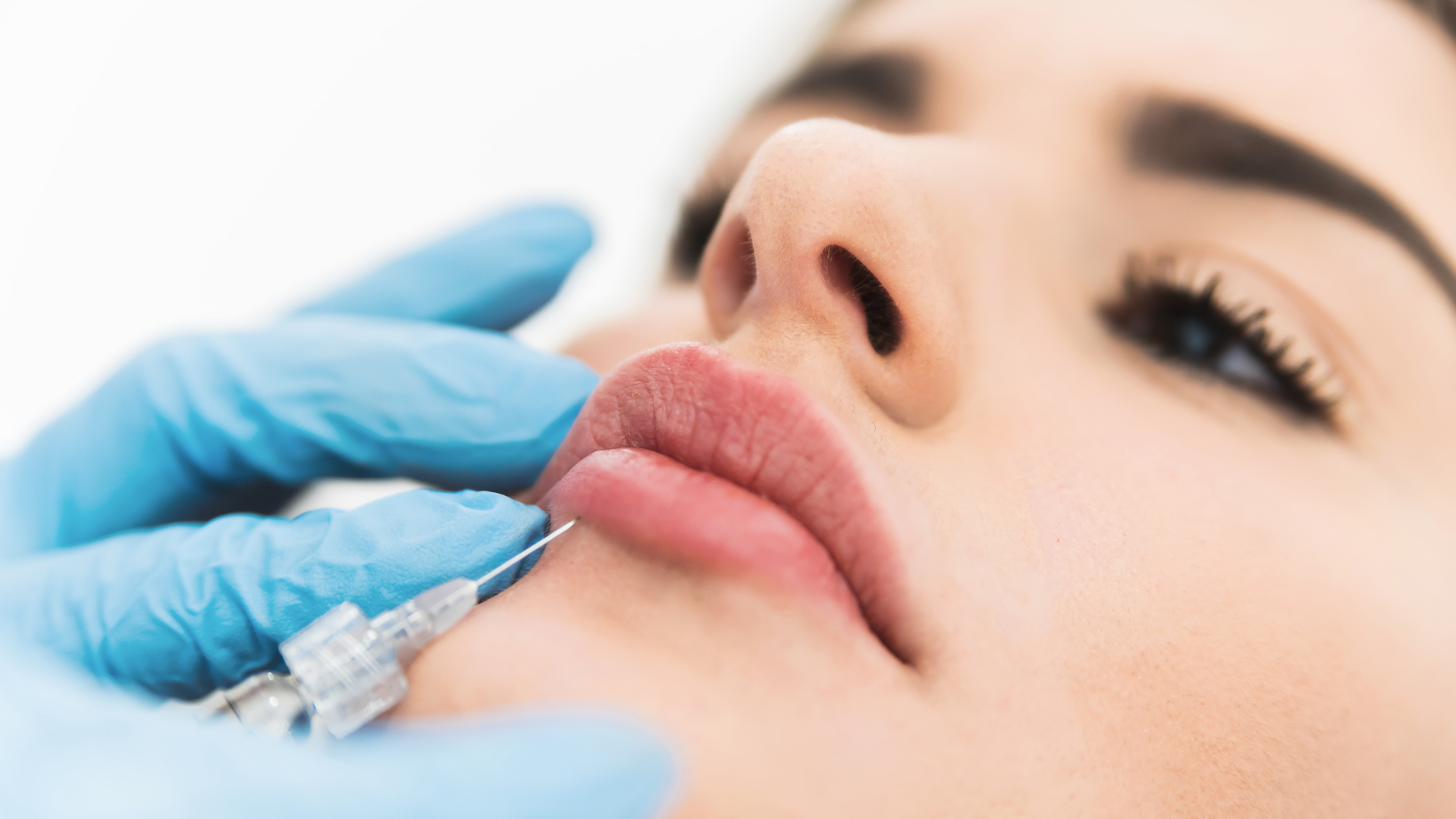 Can Thin Lips Get Lip Fillers?
