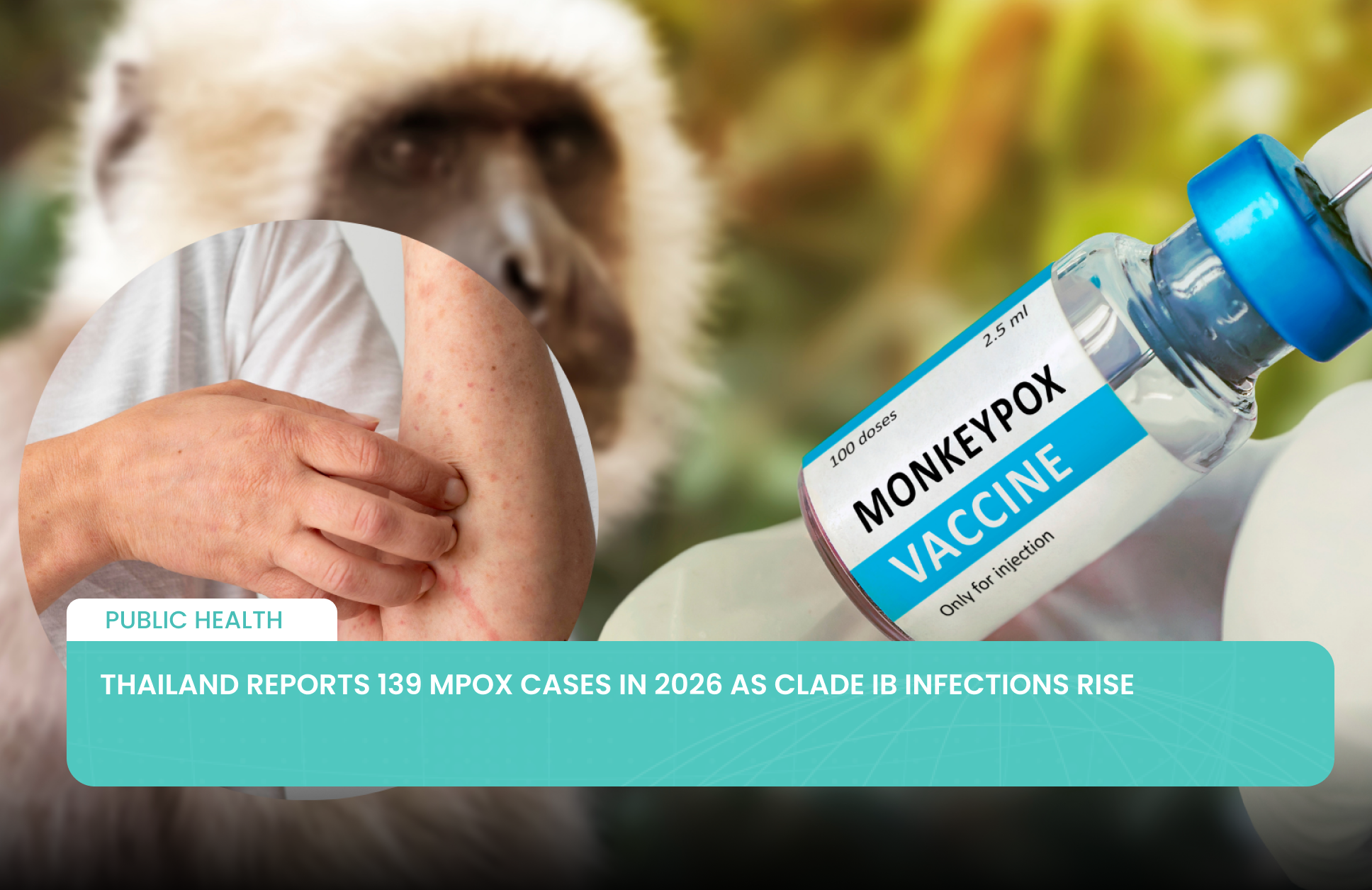 Thailand Reports 139 Mpox Cases in 2026 as Clade Ib Infections Rise