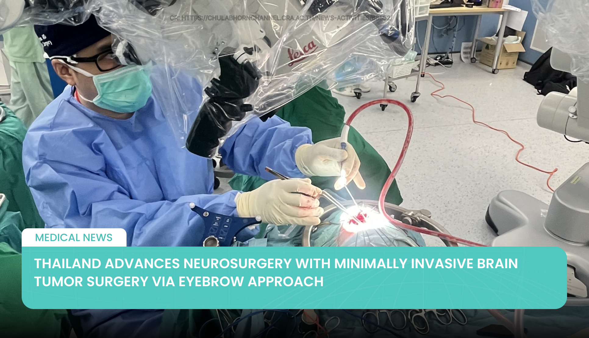 Thailand Advances Neurosurgery with Minimally Invasive Brain Tumor Surgery via Eyebrow Approach