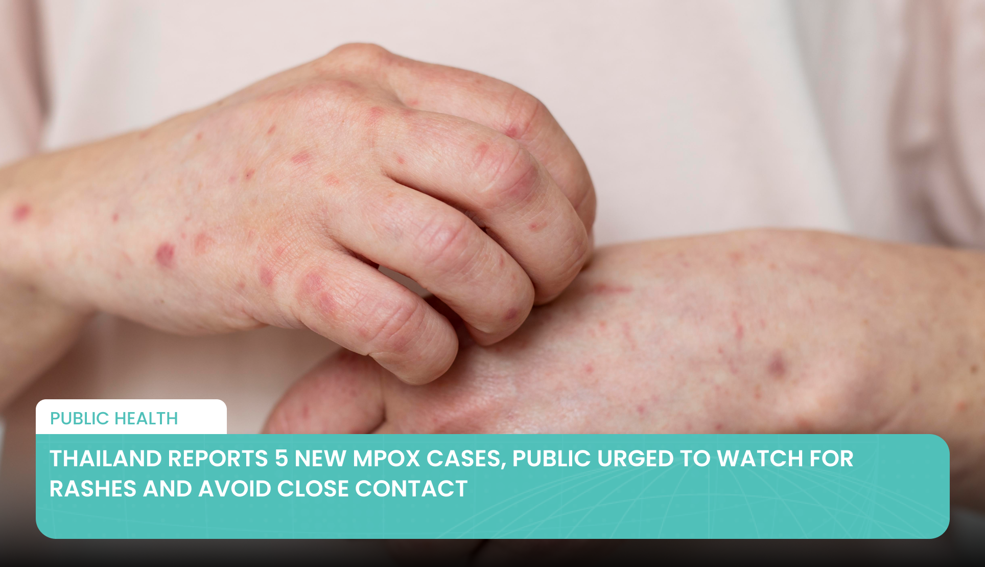 Thailand Reports 5 New Mpox Cases, Public Urged to Watch for Rashes and Avoid Close Contact