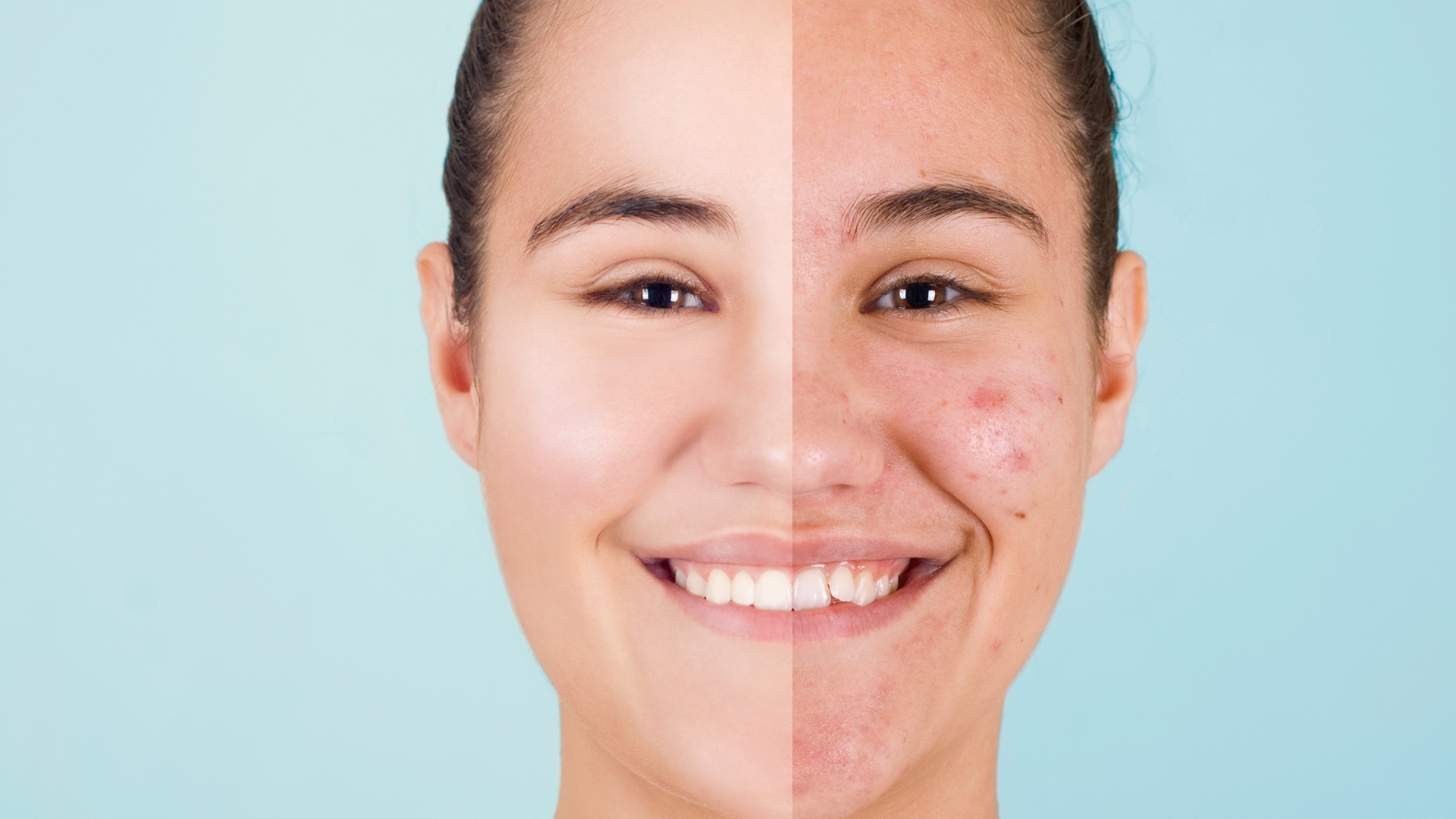 5 Effective Ways to Reduce Acne Scars