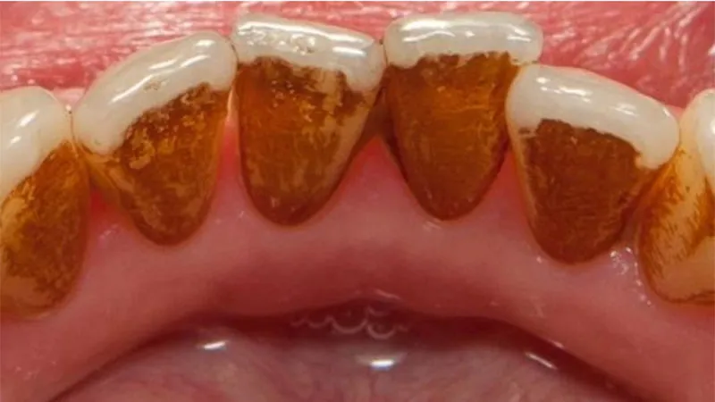 Professional Teeth Cleaning and Airflow