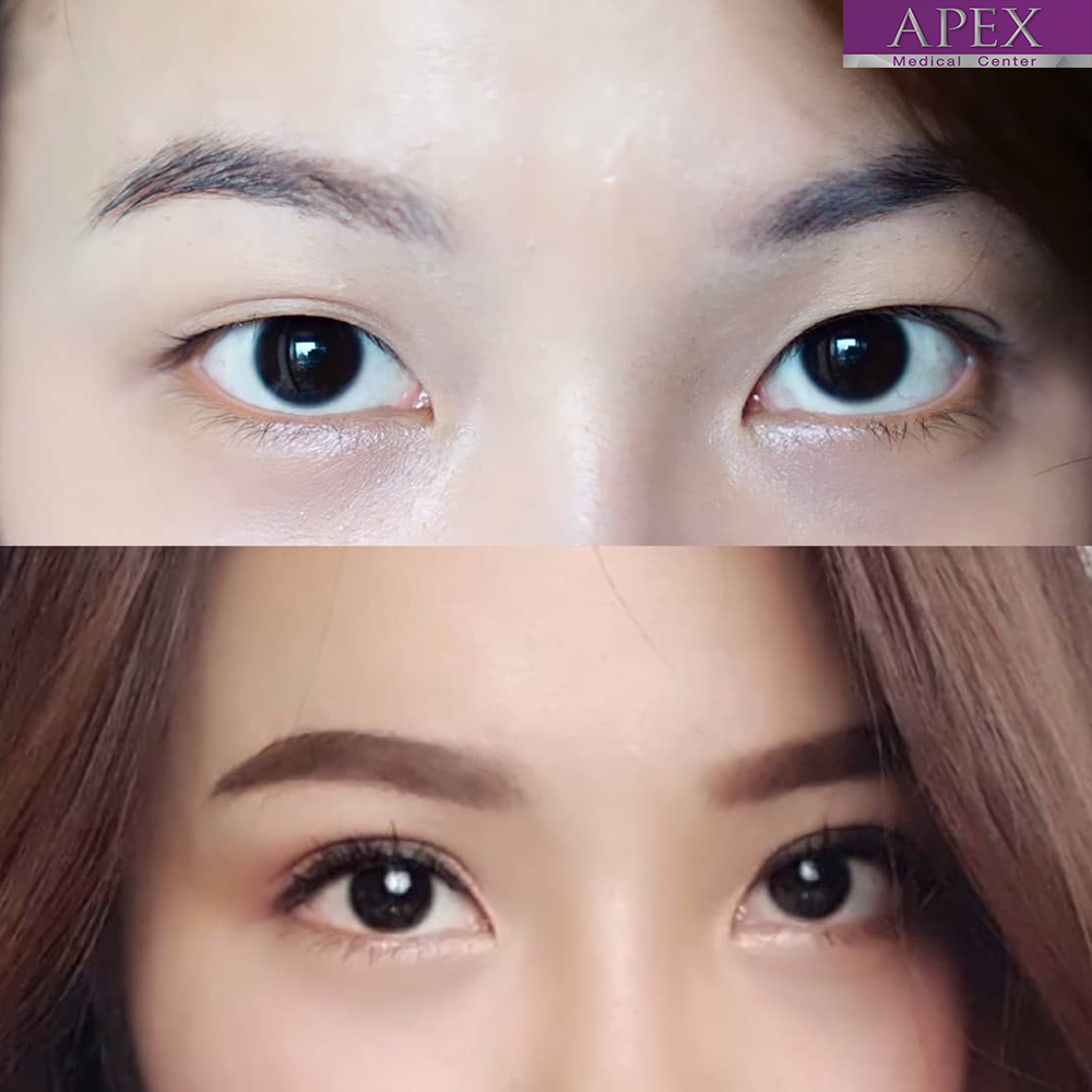 Celeb Eyes: Korean Double Eyelid Surgery for Natural, Stunning Results