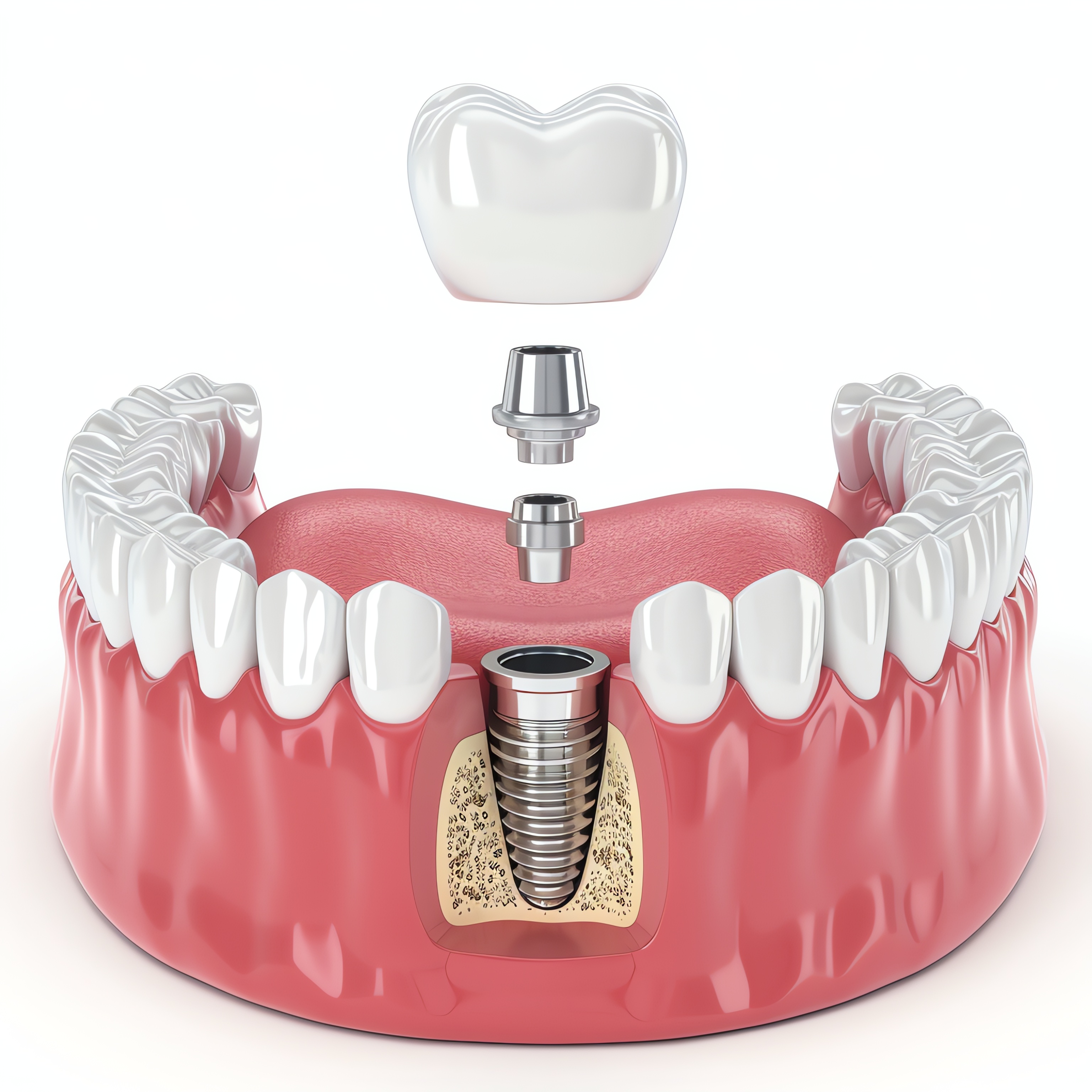  Dental Implants