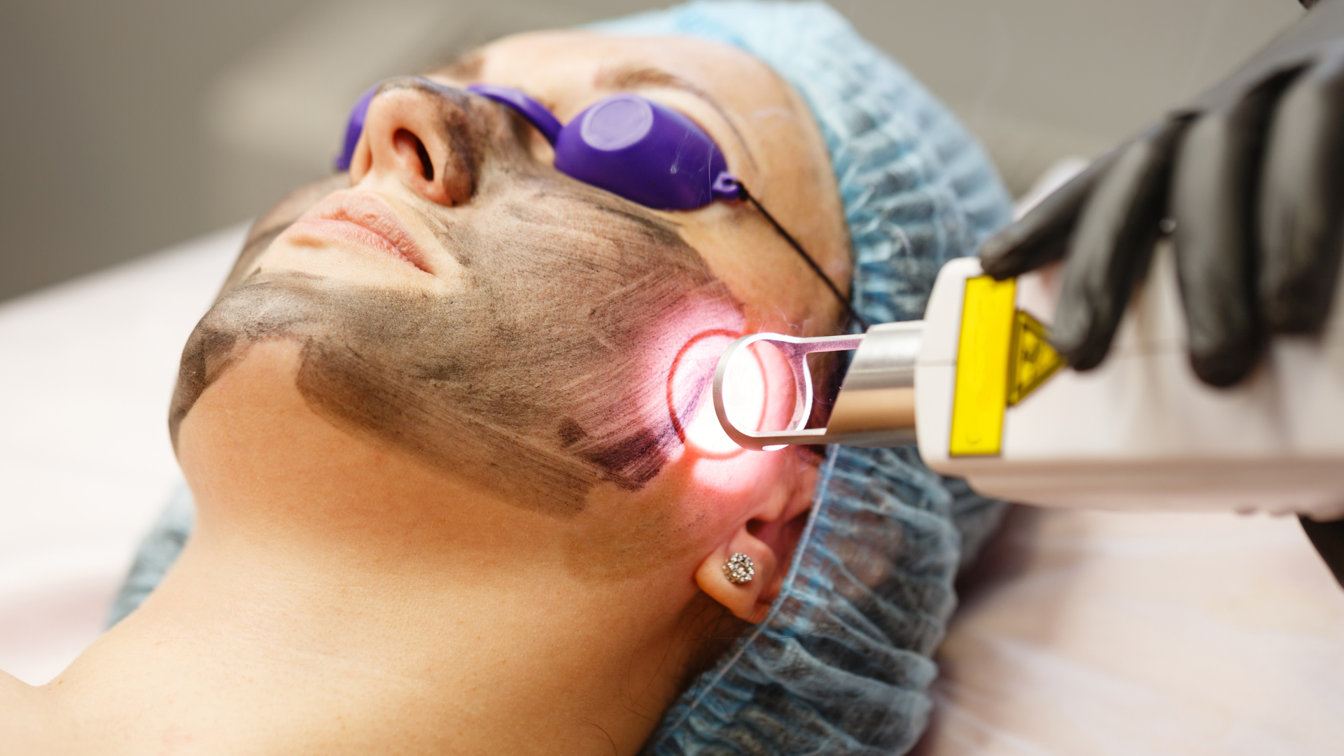 Pico Laser: A Gateway to Naturally Brighter, Smoother Skin
