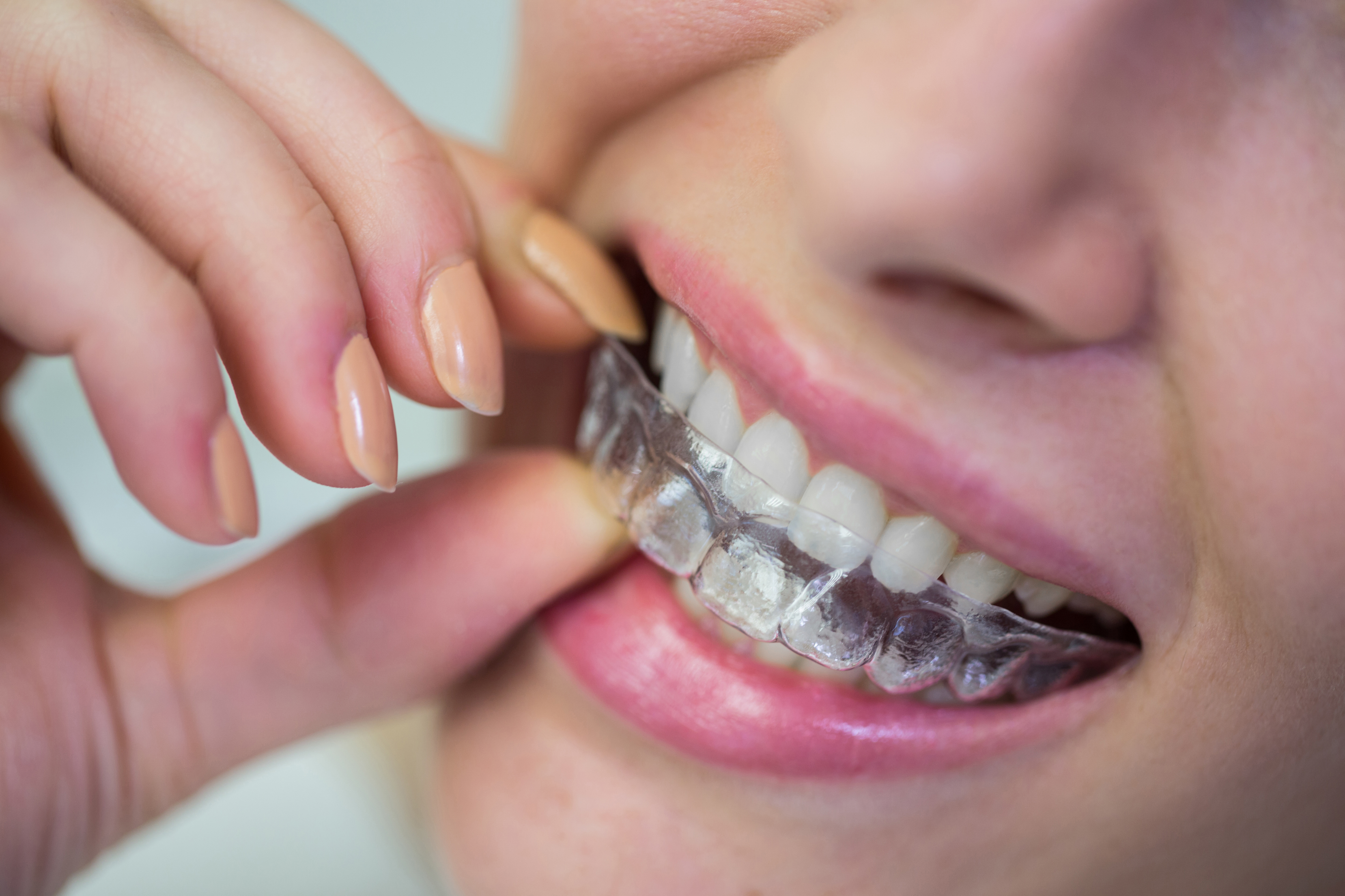  Invisalign